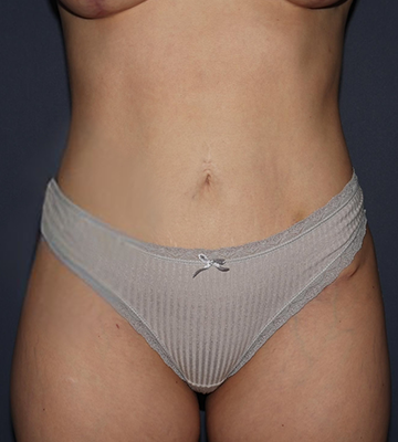 Tummy Tuck After 0165