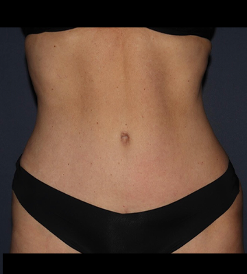Tummy Tuck After 0166