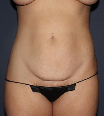 Tummy Tuck Before 0165
