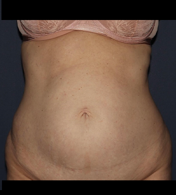 Tummy Tuck Before 0166
