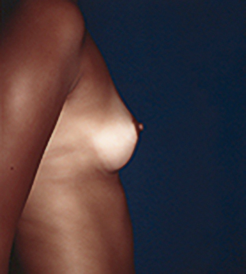 Breast-Augmentation-Saline-Case0104-bef-rt