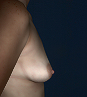 Breast-Augmentation-Saline-Case0106-bef-rt