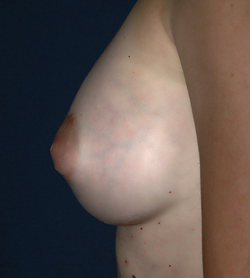 Breast-Augmentation-Saline-Case0108-aft-lf