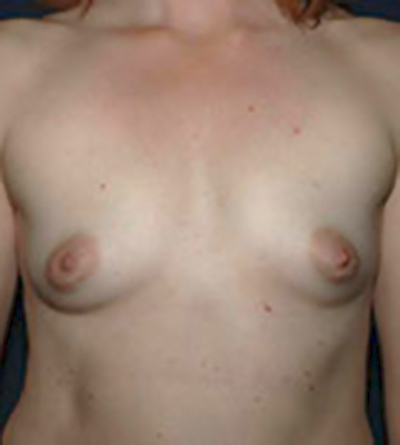 Breast-Augmentation-Saline-Case0108-bef-fr