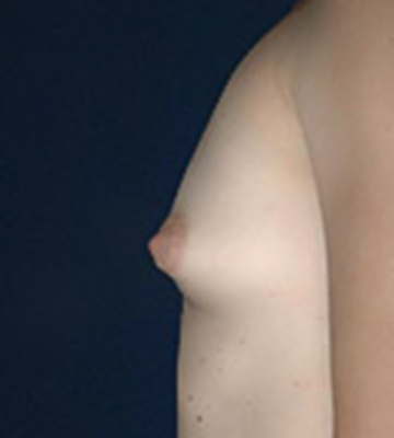 Breast-Augmentation-Saline-Case0108-bef-lf