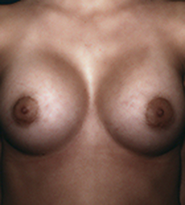 Breast-Augmentation-Saline-Case0110-aft-fr