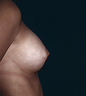 Breast-Augmentation-Saline-Case0110-aft-rt