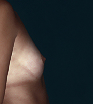 Breast-Augmentation-Saline-Case0110-bef-rt