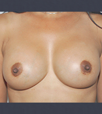 Breast-Augmentation-Saline-Case0112-aft-fr