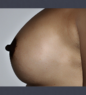 Breast-Augmentation-Saline-Case0112-aft-lf