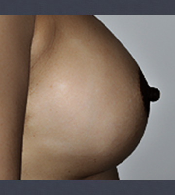 Breast-Augmentation-Saline-Case0112-aft-rt
