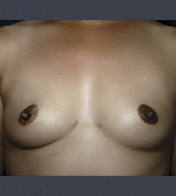 Breast-Augmentation-Saline-Case0112-bef-fr