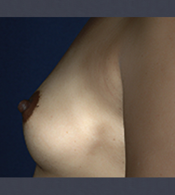Breast-Augmentation-Saline-Case0112-bef-lf