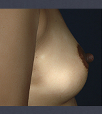 Breast-Augmentation-Saline-Case0112-bef-rt