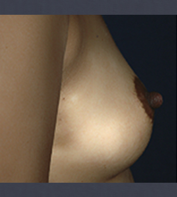 Breast-Augmentation-Saline-Case0112-bef-rt