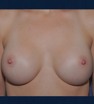 Breast-Augmentation-Saline-Case0114-aft-fr