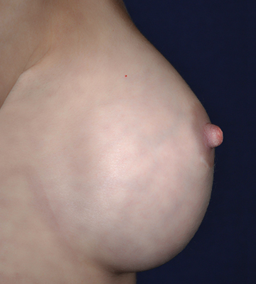 Breast-Augmentation-Saline-Case0114-aft-rt