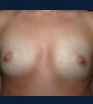 Breast-Augmentation-Saline-Case0114-bef-fr