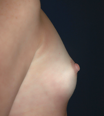Breast-Augmentation-Saline-Case0114-bef-rt