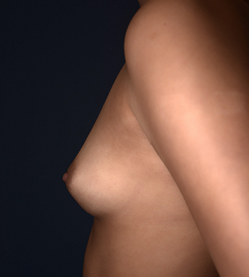 Breast-Augmentation-Silicone-Case0101-bef-lf