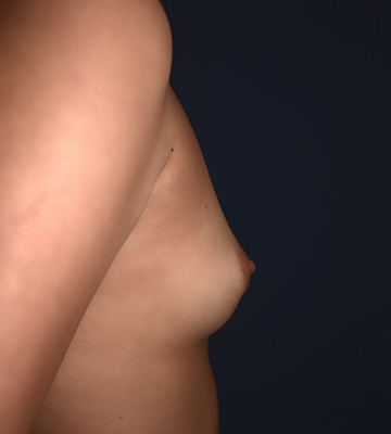 Breast-Augmentation-Silicone-Case0101-bef-rt