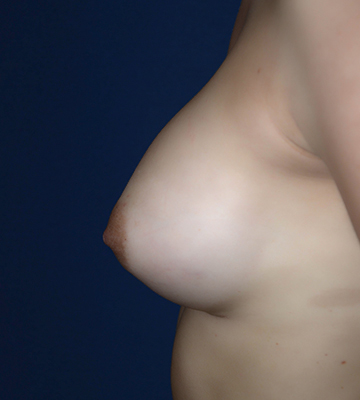 Breast-Augmentation-Silicone-Case0103-aft-lf