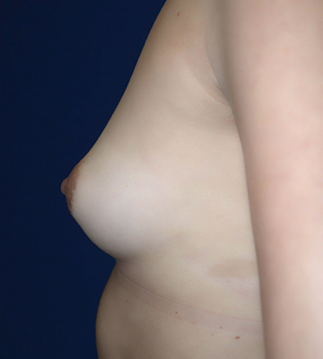 Breast-Augmentation-Silicone-Case0103-bef-lf