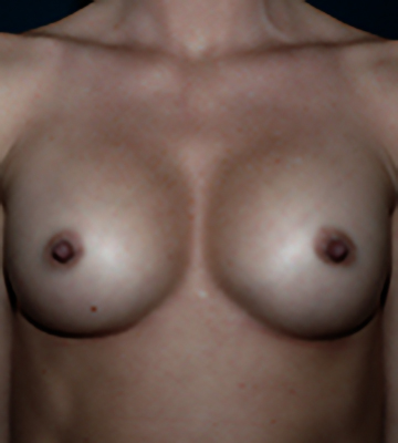 Breast-Augmentation-Silicone-Case0107-aft-fr