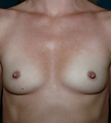 Breast-Augmentation-Silicone-Case0107-bef-fr