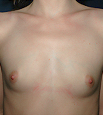 Breast-Augmentation-Silicone-Case0109-bef-fr
