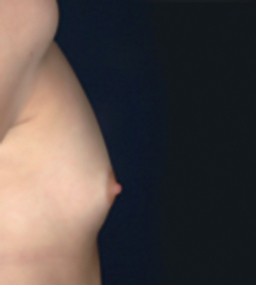 Breast-Augmentation-Silicone-Case0109-bef-rt