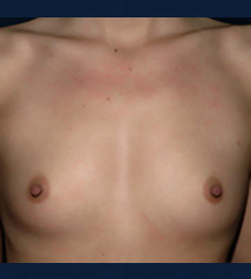 Breast-Augmentation-Silicone-Case0111-bef-fr