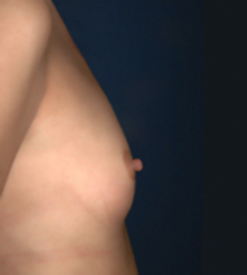 Breast-Augmentation-Silicone-Case0111-bef-rt