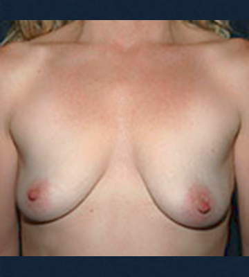 Breast-Augmentation-Silicone-Case0113-bef-fr