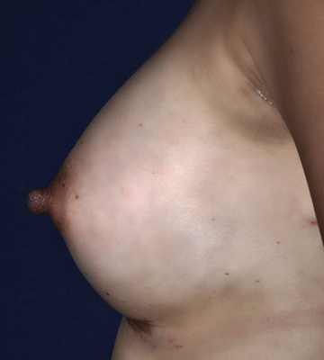 Breast-Augmentation-Silicone-Case0115-aft-lf