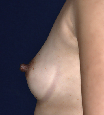 Breast-Augmentation-Silicone-Case0115-bef-lf