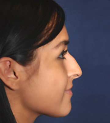 Nose-Reshaping-Case0193-bef-rt