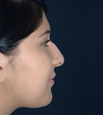 Nose-Reshaping-Case0194-bef-rt