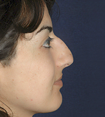 Nose-Reshaping-Case0195-bef-rt