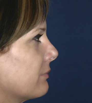Nose-Reshaping-Case0196-aft-rt