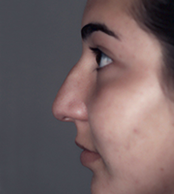Nose-Reshaping-Case0198-bef-lf
