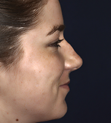 Nose-Reshaping-Case0202-bef-rt