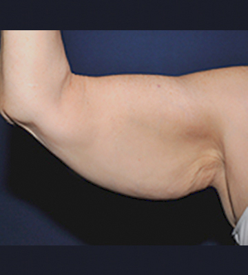 Reconstruction-Aft-Weight-Loss-Case0182-bef-frrt