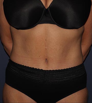 Tummy Tuck After 0160