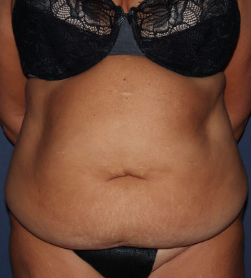 Tummy Tuck Before 0160