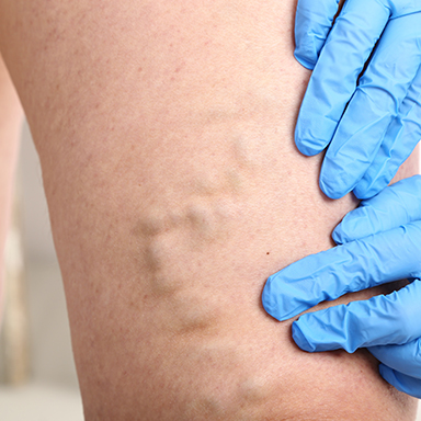 varicose treatment